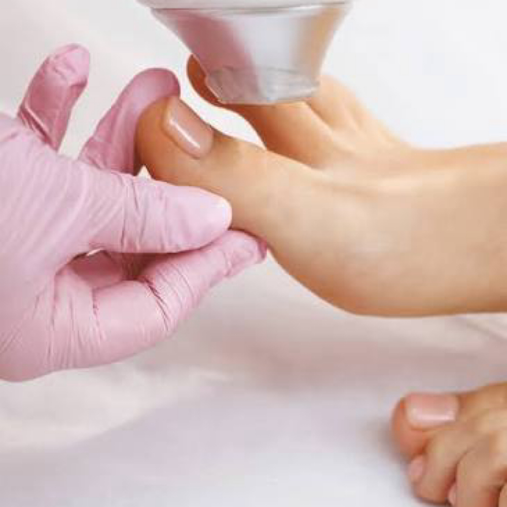 Laser Hair Removal (toes Treatment) at All Aesthetics Kare in Upland, CA