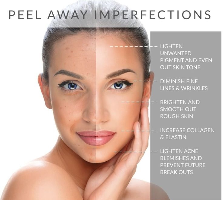 ChemicalPeel to Clear/Firm/Brighten