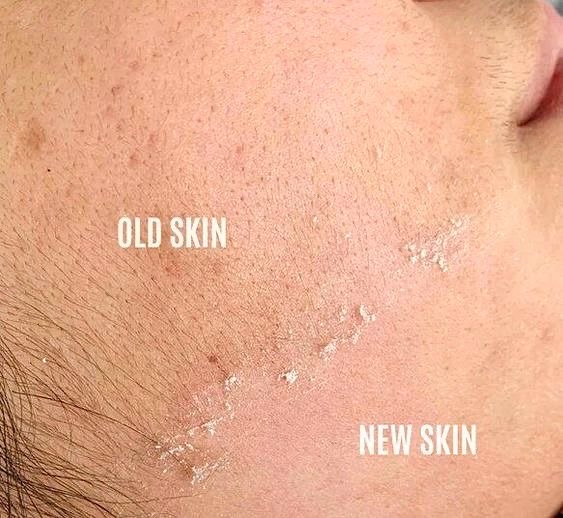 DERMAPLANING