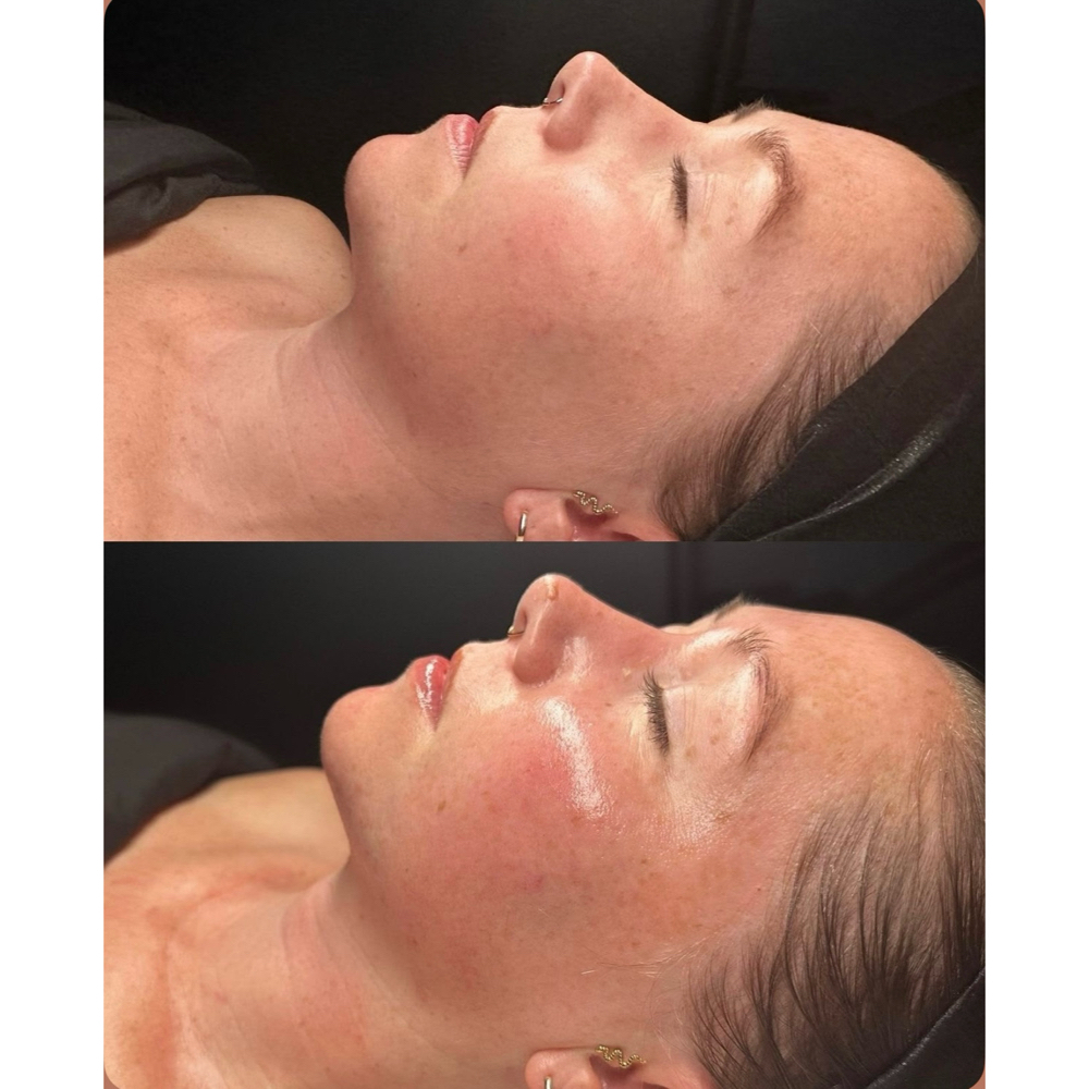 Alpha/Beta Corrective Peel at PureBeauty-Aesthetics in Colorado Springs, CO
