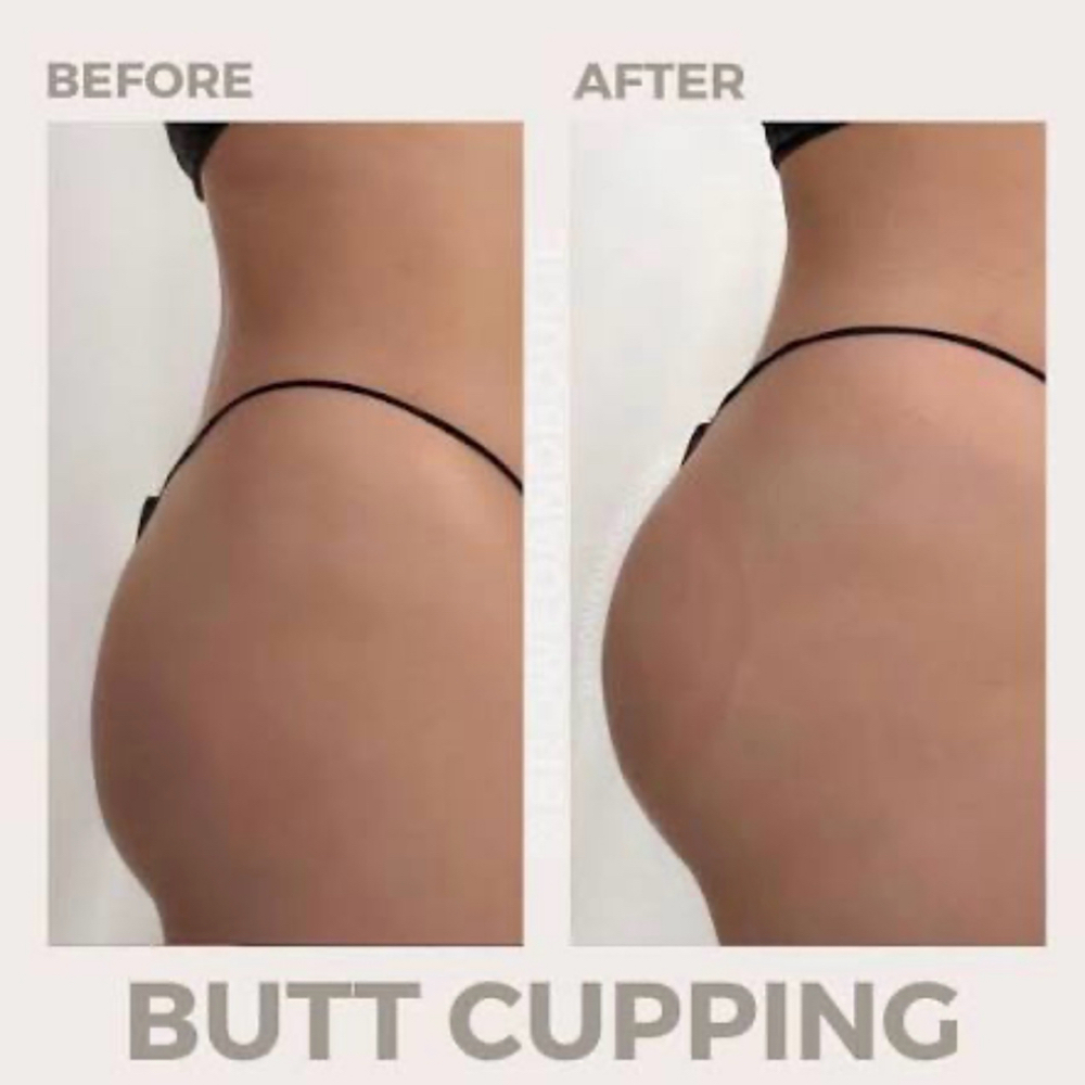 Gluteal Vacuum Therapy at D’Aura Esthetics in Salem, OR