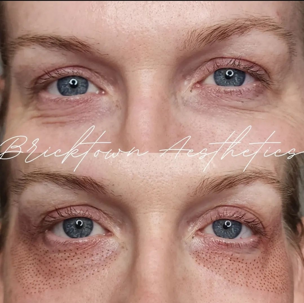 Lower Eyelid Tightening