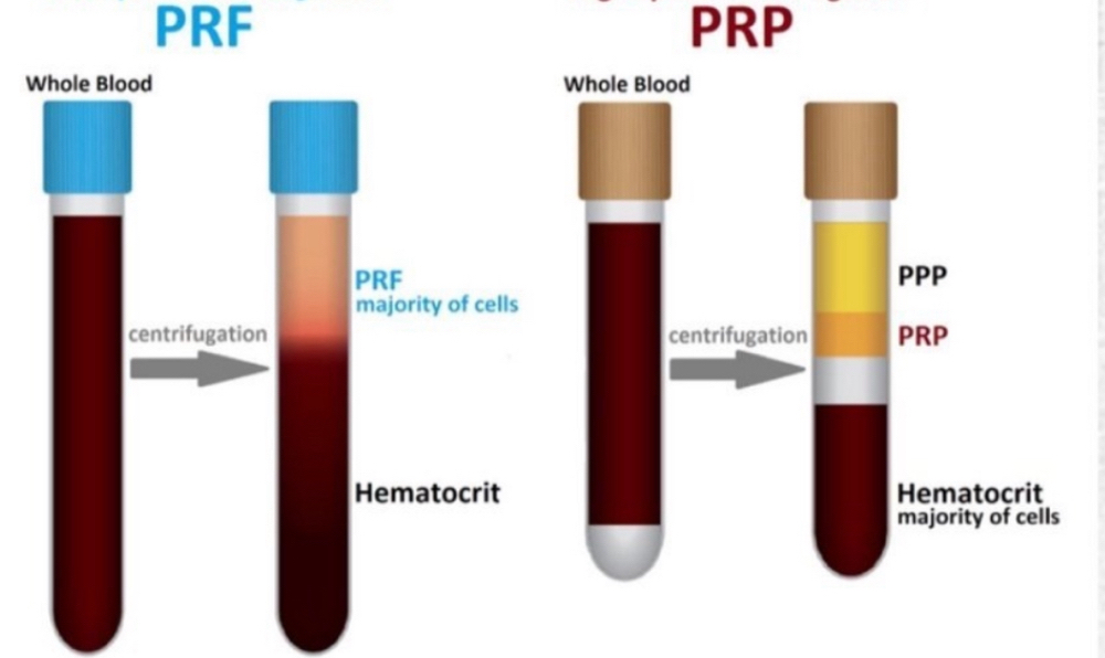 PRP Injections