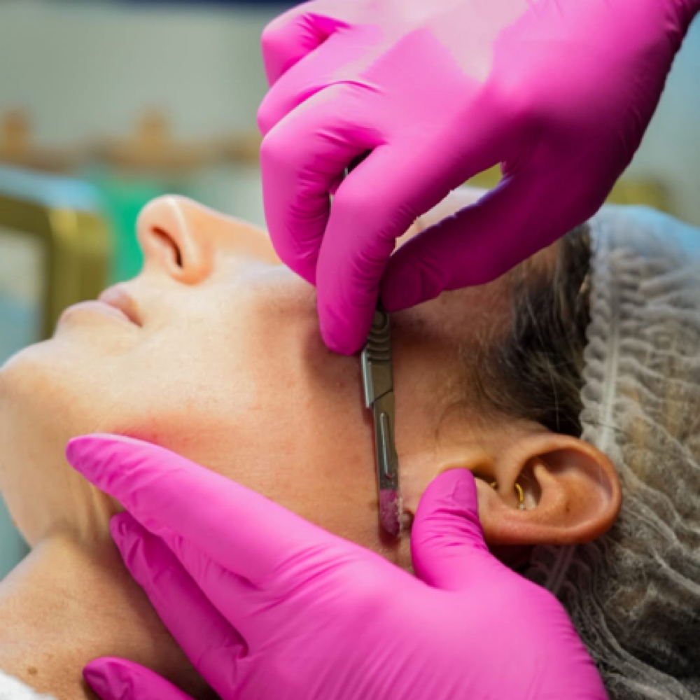 Dermaplaning Facial at CC Esthetics in Hampstead, NC