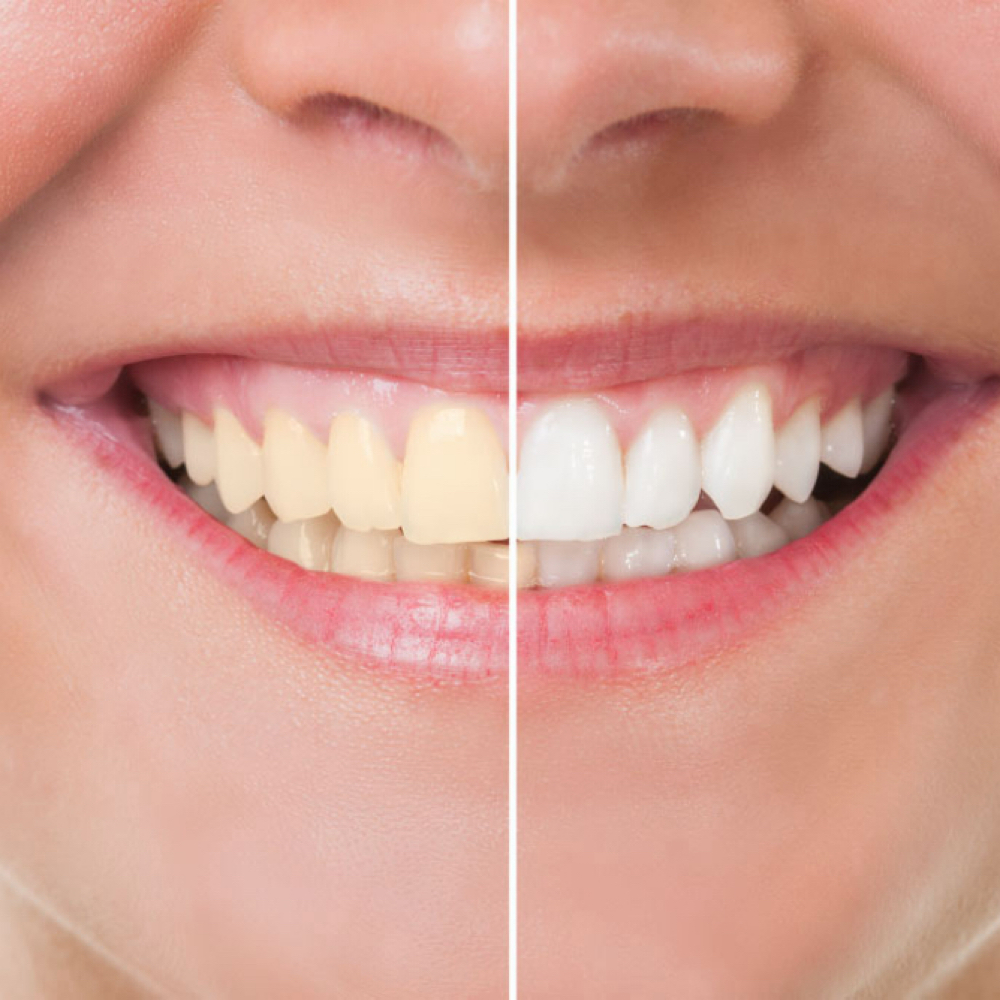 Teeth Whitening at Euphoria Skin & Hair in Goodyear, AZ