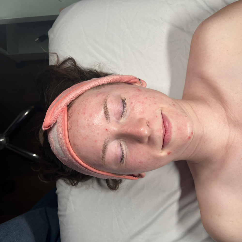 Acne Treatment Facial