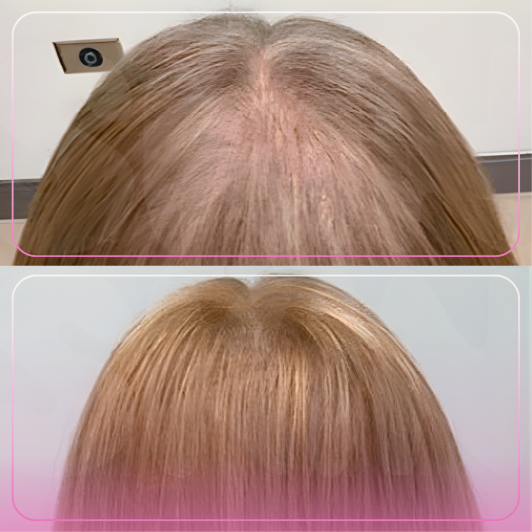 Hair Restoration- 3 treatments