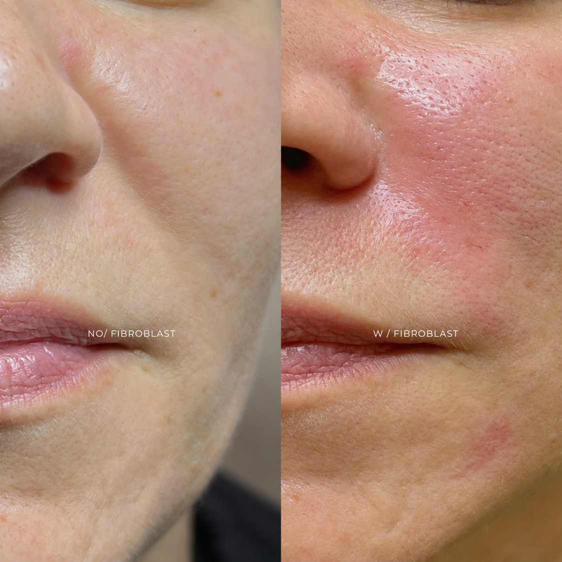 FIBROBLAST | NASOLABIAL at EROXSPA in Houston, TX