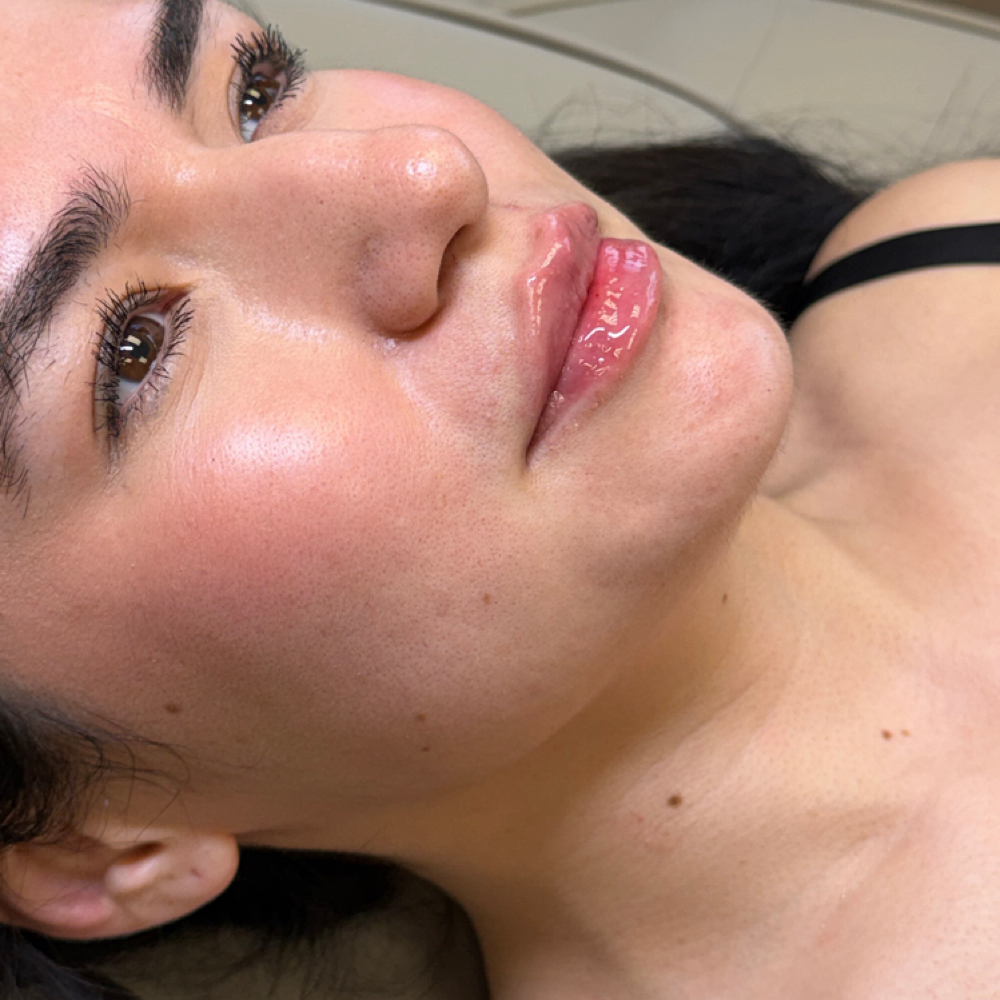 Lip Filler at Body and Aesthetics in Houston, TX