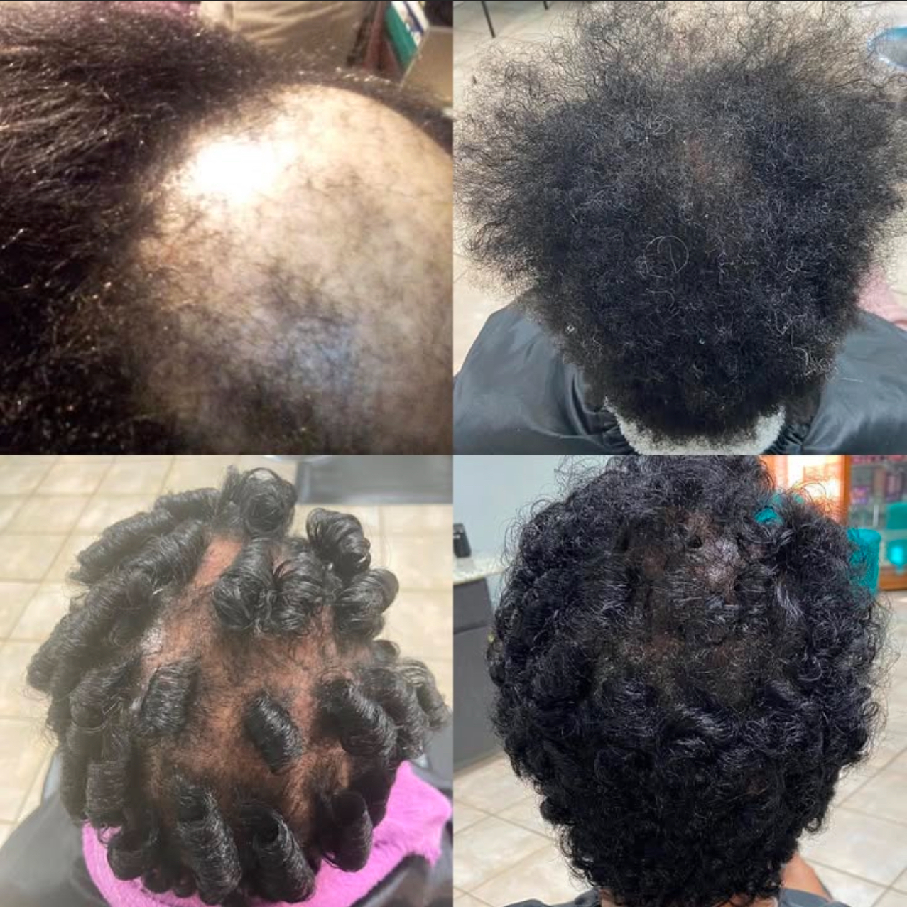 Scalp rejuvenation therapy