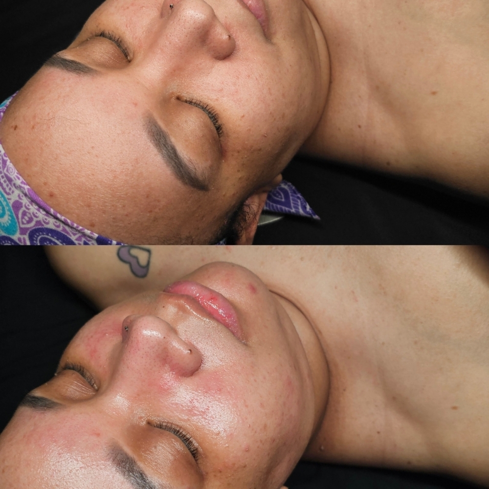 The Acne Facial at Aligned Beauty & Wellness in Davenport, IA