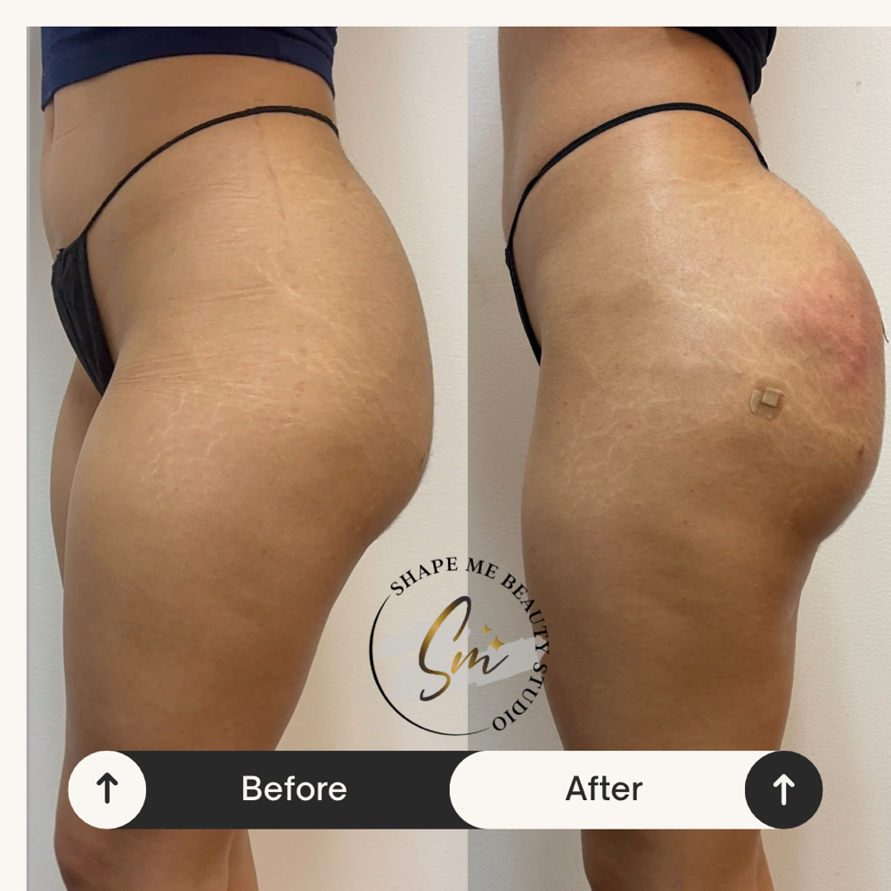 Liquid BBL 400cc at Shape Me Beauty Studio in Midland, TX