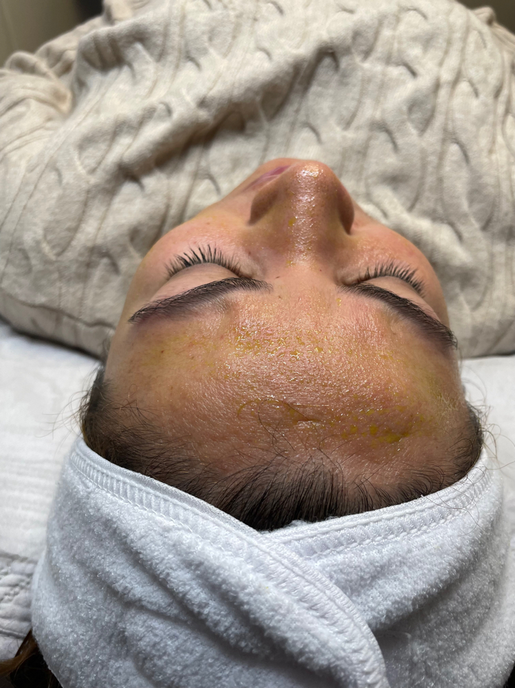 BioRePeel Facial