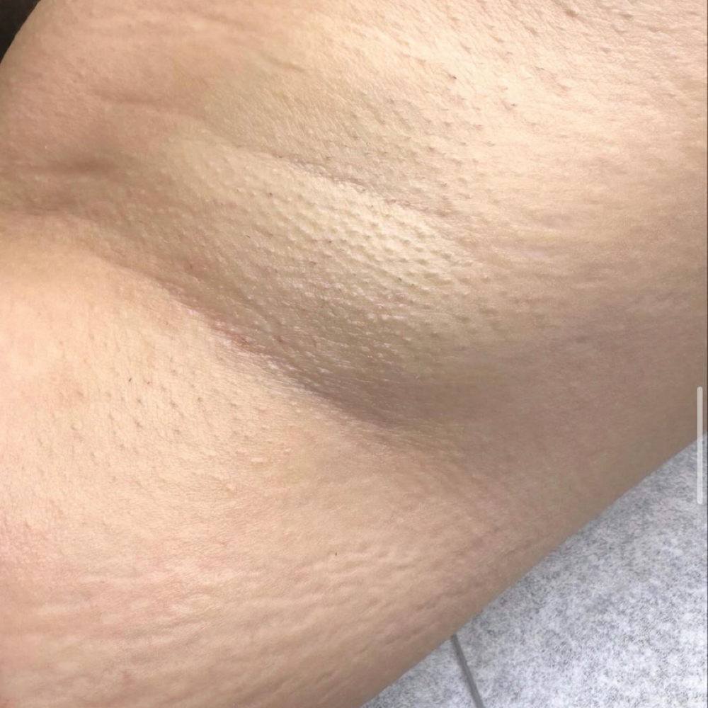 Underarm Wax at Liv Beautiful Esthetics in CA, CA