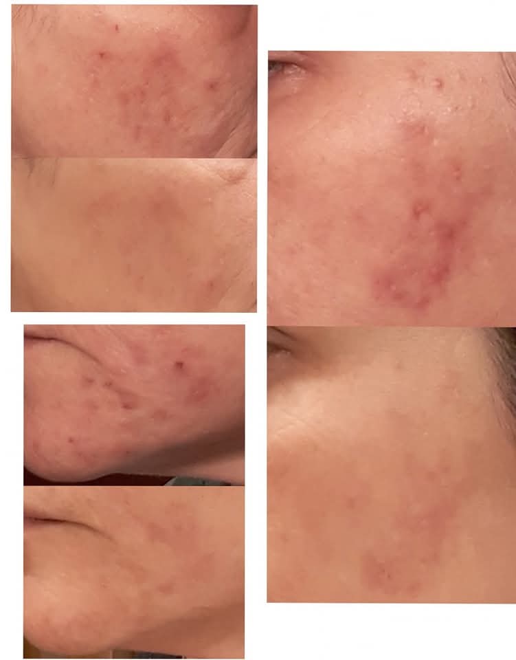 Skin Clearing Facial (Acne)