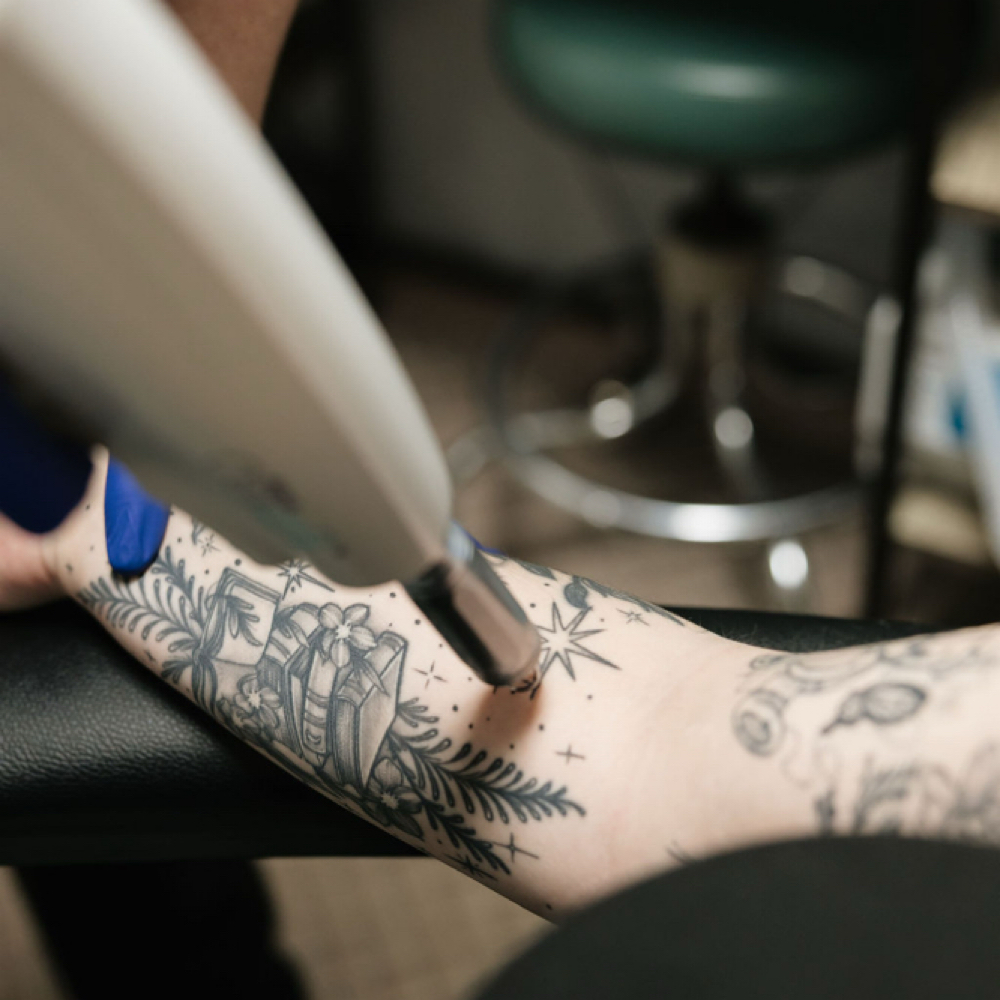 Tattoo Removal at Angel Care Health and Wellness in Knoxville, TN