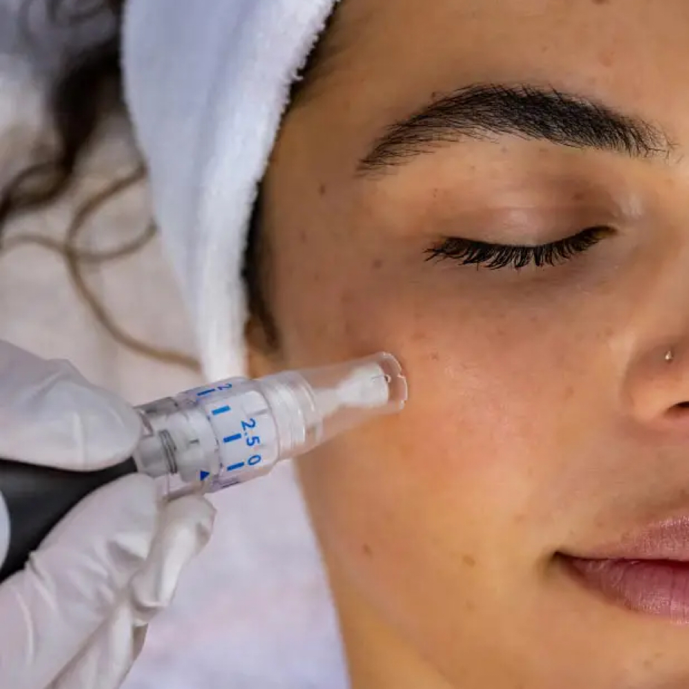 Glass Skin Effect Microneedling at Elevate RN Aesthetics in Mcallen, TX