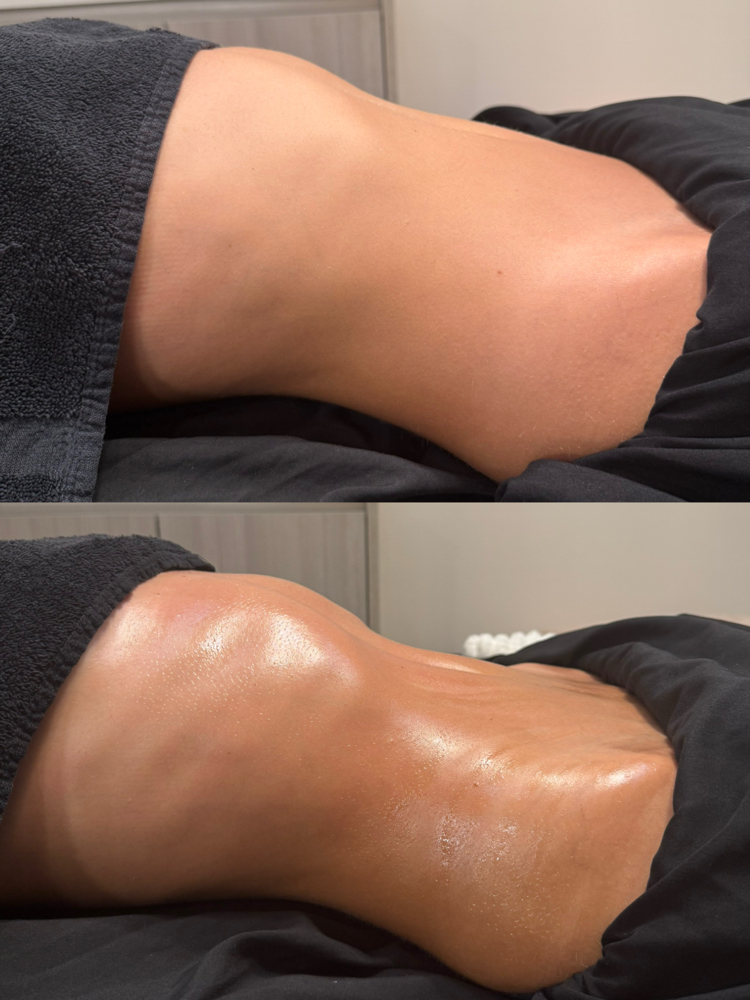 Body Cupping Therapy