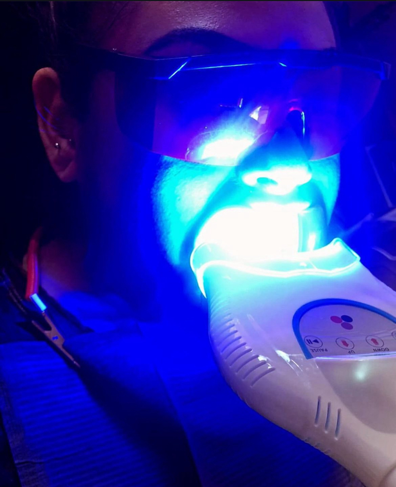 Teeth Whitening 1 Hour Session