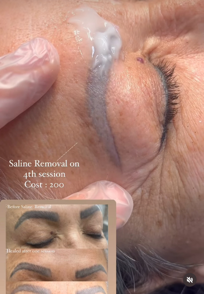 Saline Solution Removal