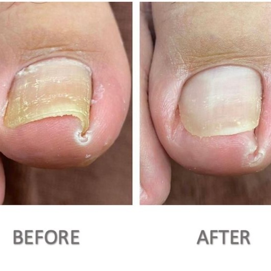 Ingrown Toe nails at Beyond Flawless Solutions, LLC in Garland, TX