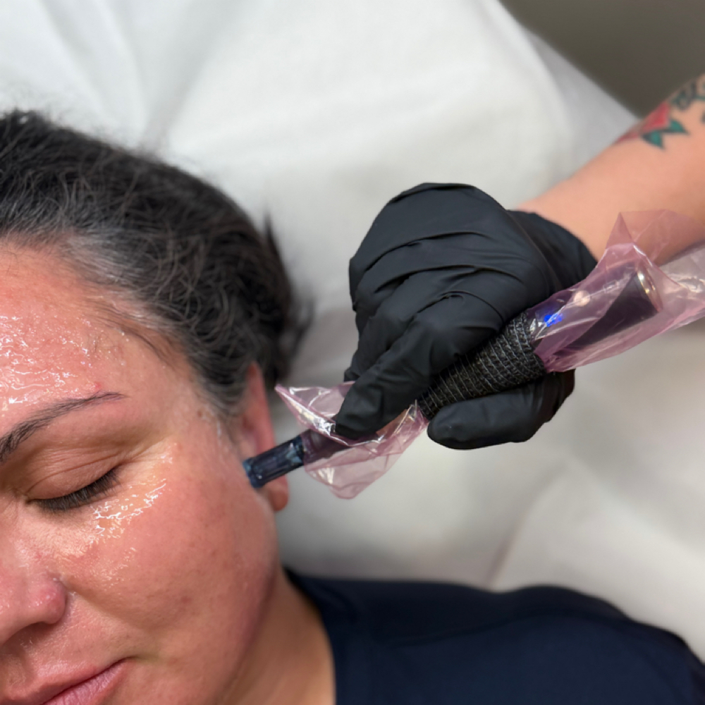 PRP MICRONEEDLE - Vampire Facial at Marissa - Aesthetic Nurse in Alice, TX