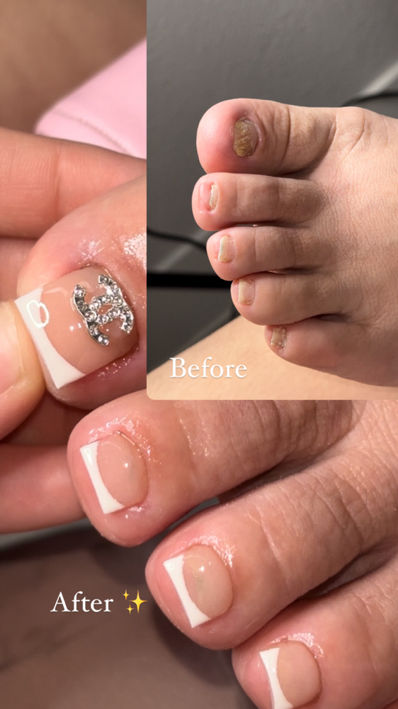 Toe Reconstruction