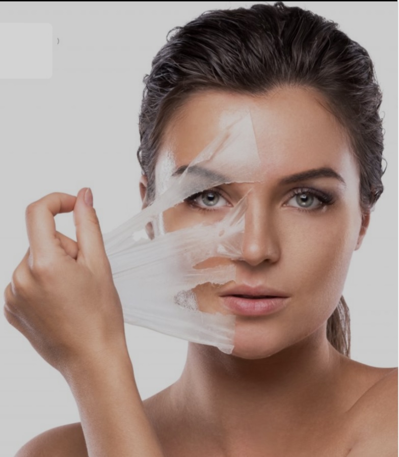 VI Chemical Peel