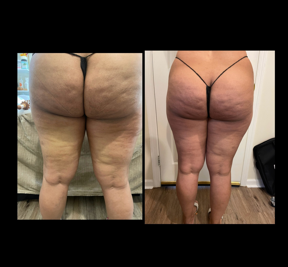 Reduccion Piernas Brazos Celulitie