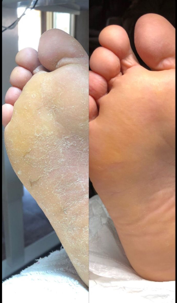 Deep Treatment Callus Remover