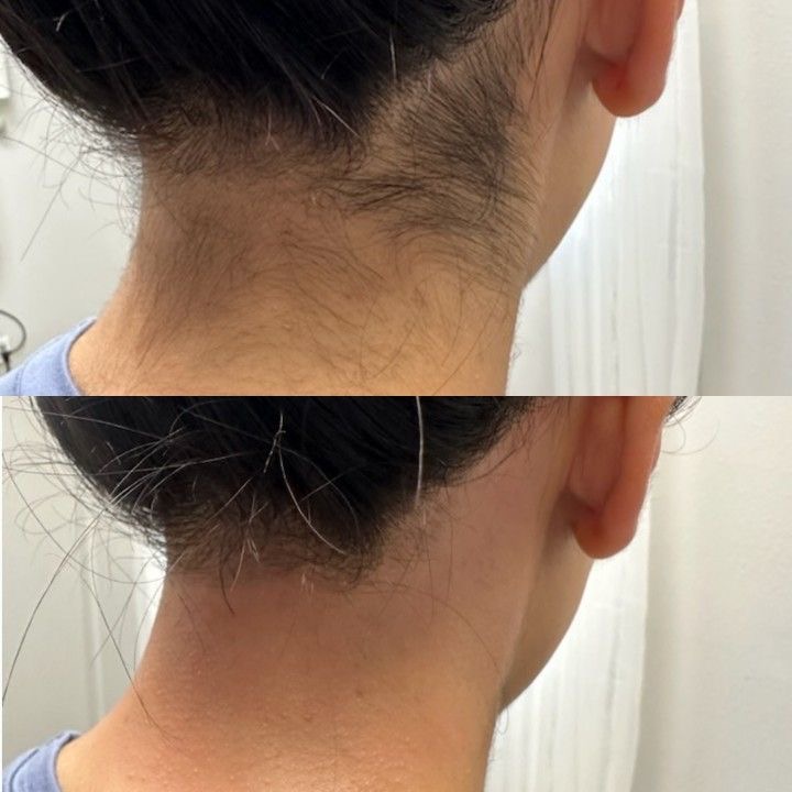 Neck Hairline Hair Removal at Yulee Mac Aesthetics in Tontitown, AR