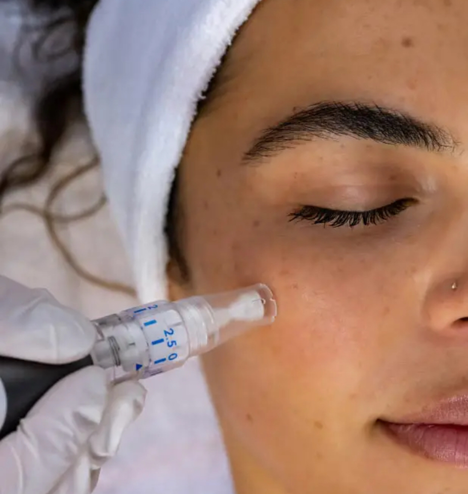 Microneedling 1 Session