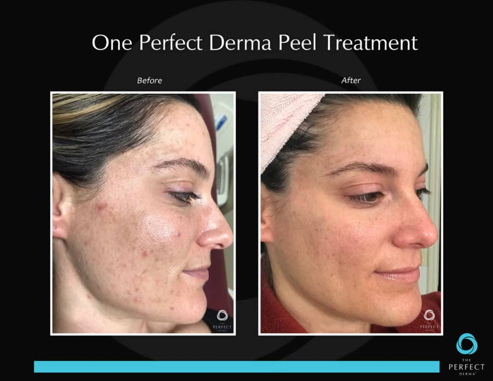 The Perfect Derma Peel