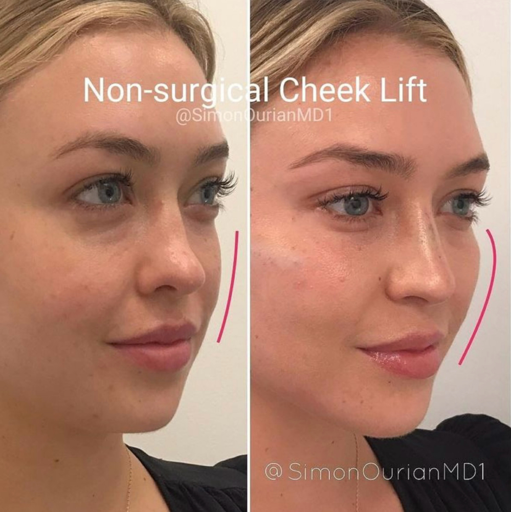 Cheek Filler at Lc Beauty Vault in Sinton, TX
