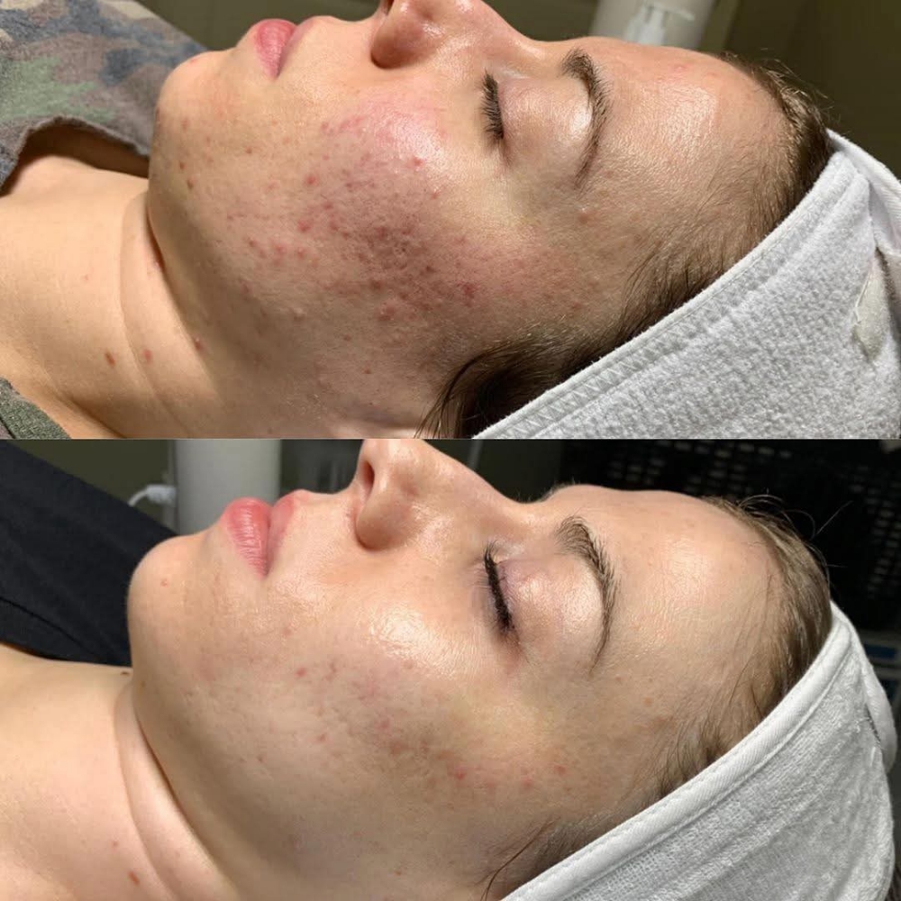 Chemical Peel