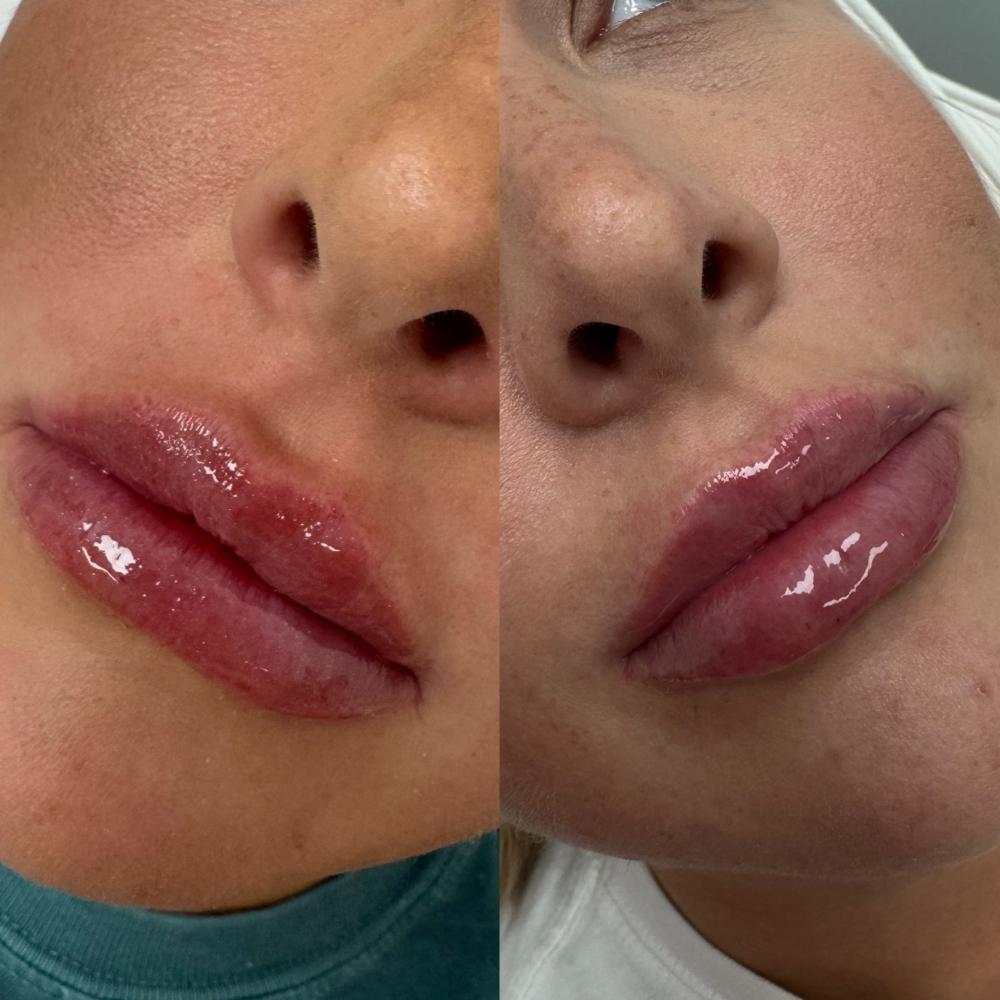 Full syringe (lips) & 30 Units