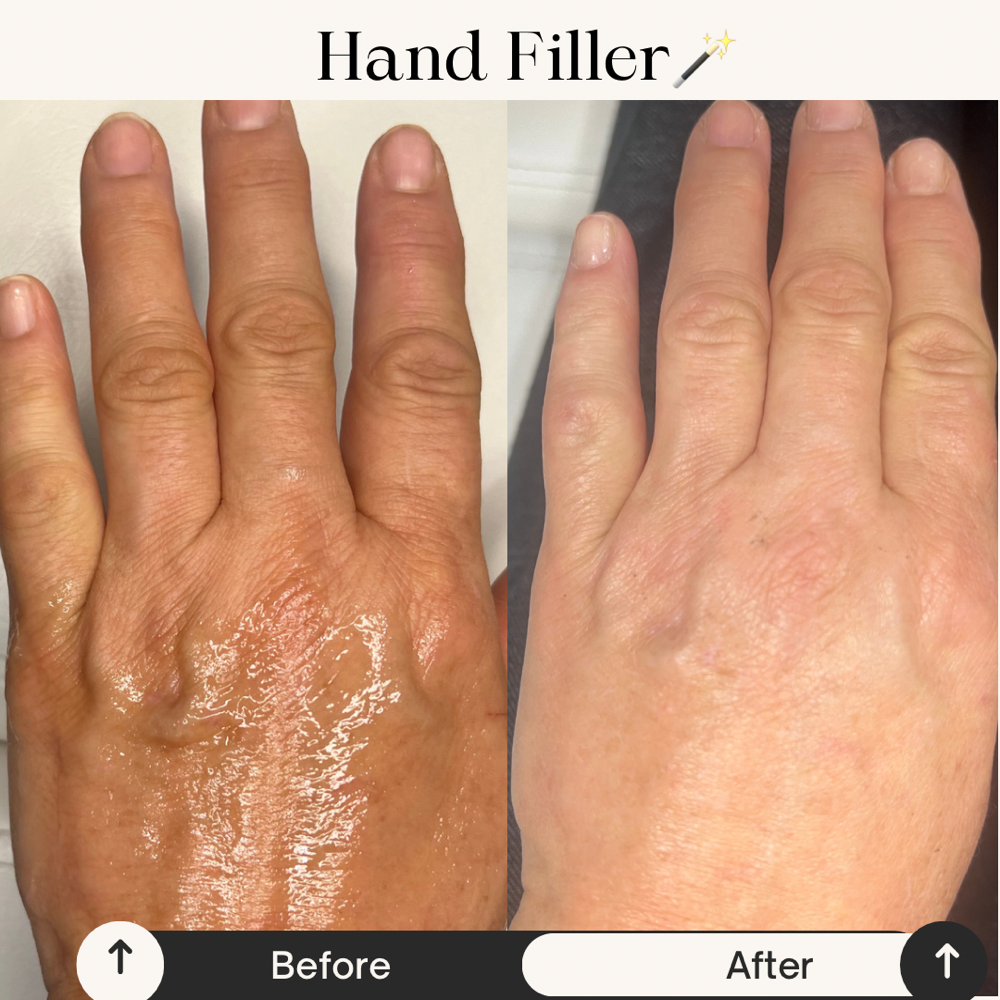 Hand Rejuvenation & Fill