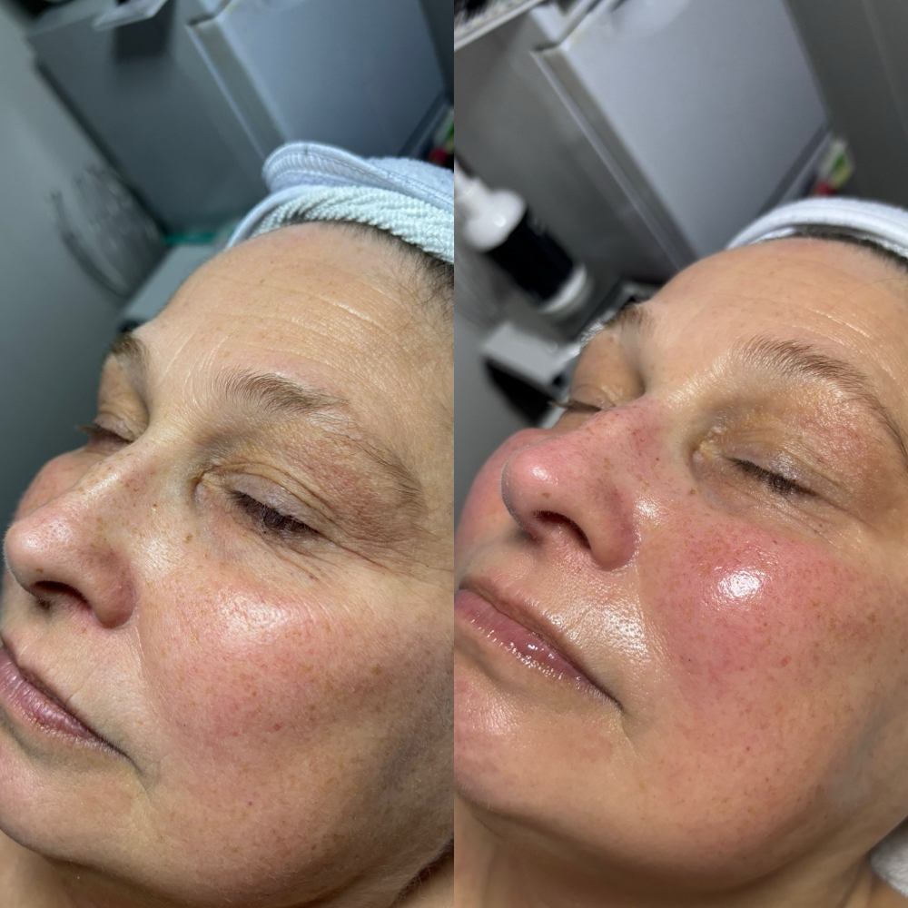 90 Minute Facial at KateVEsthetics in Milton, DE