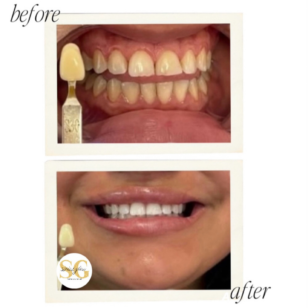 Moderate Treatment▫️one client at Sirius Glow Teeth Whitening in Pasadena, TX