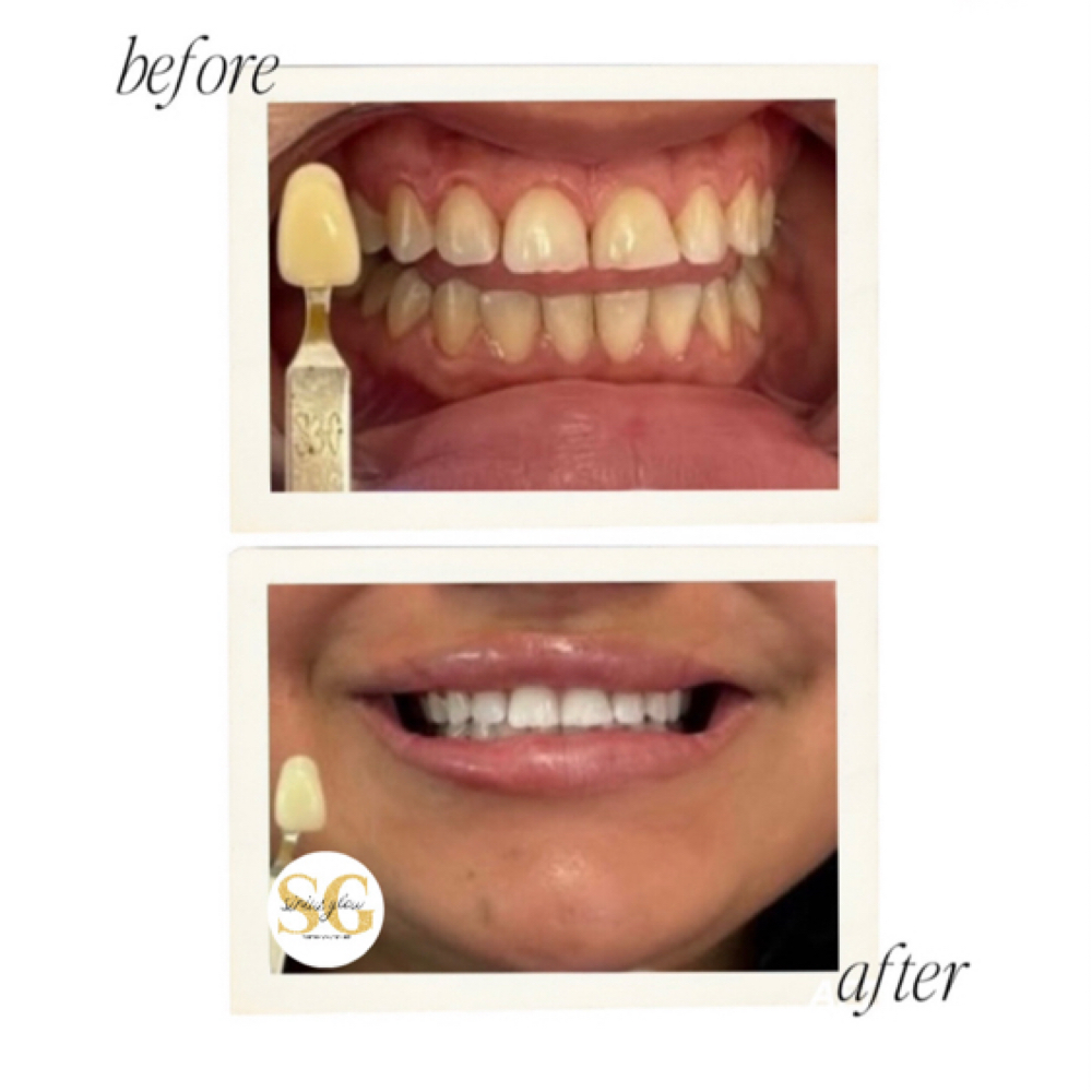 Moderate Treatment▫️one client at Sirius Glow Teeth Whitening in Pasadena, TX