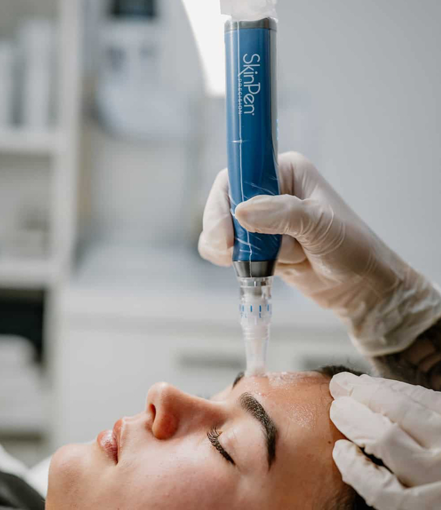 SkinPen With Growth Factors