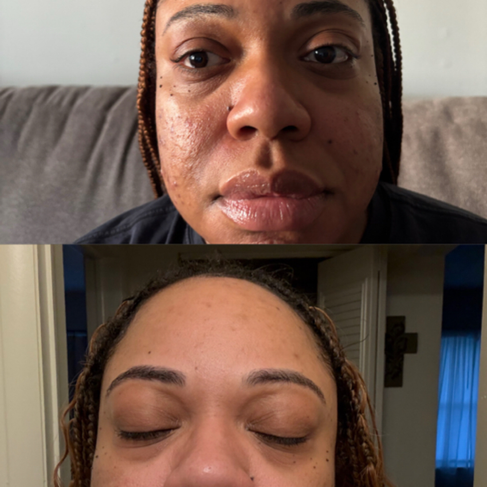 Virtual Clear Skin Follow Up