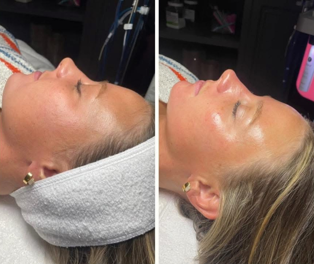 Hydrafacial