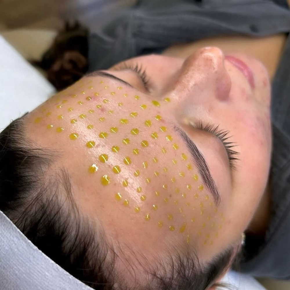 No Peel Peel at Aurora Glow Aesthetics in Spring, TX