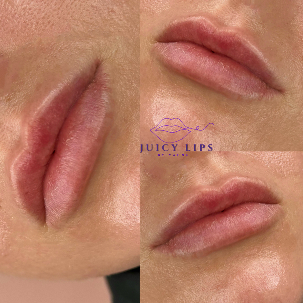 Lip Filler 1.1/2 ML Without Needle at Dfwbrowsbyvannemorales.com in Fort Worth, TX