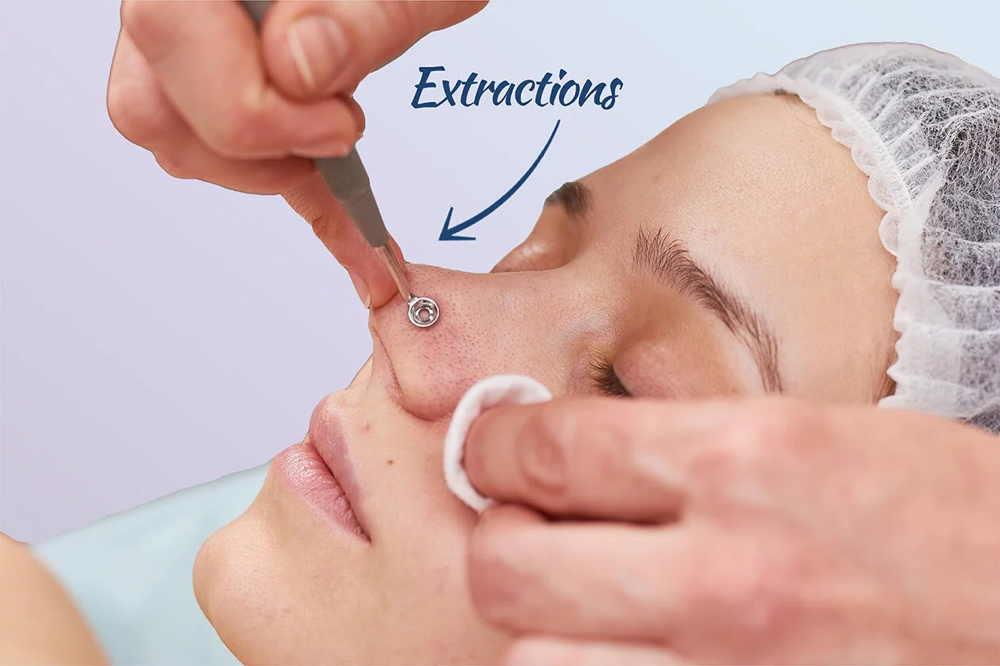 4 Sessions Acne Facial W Extraction
