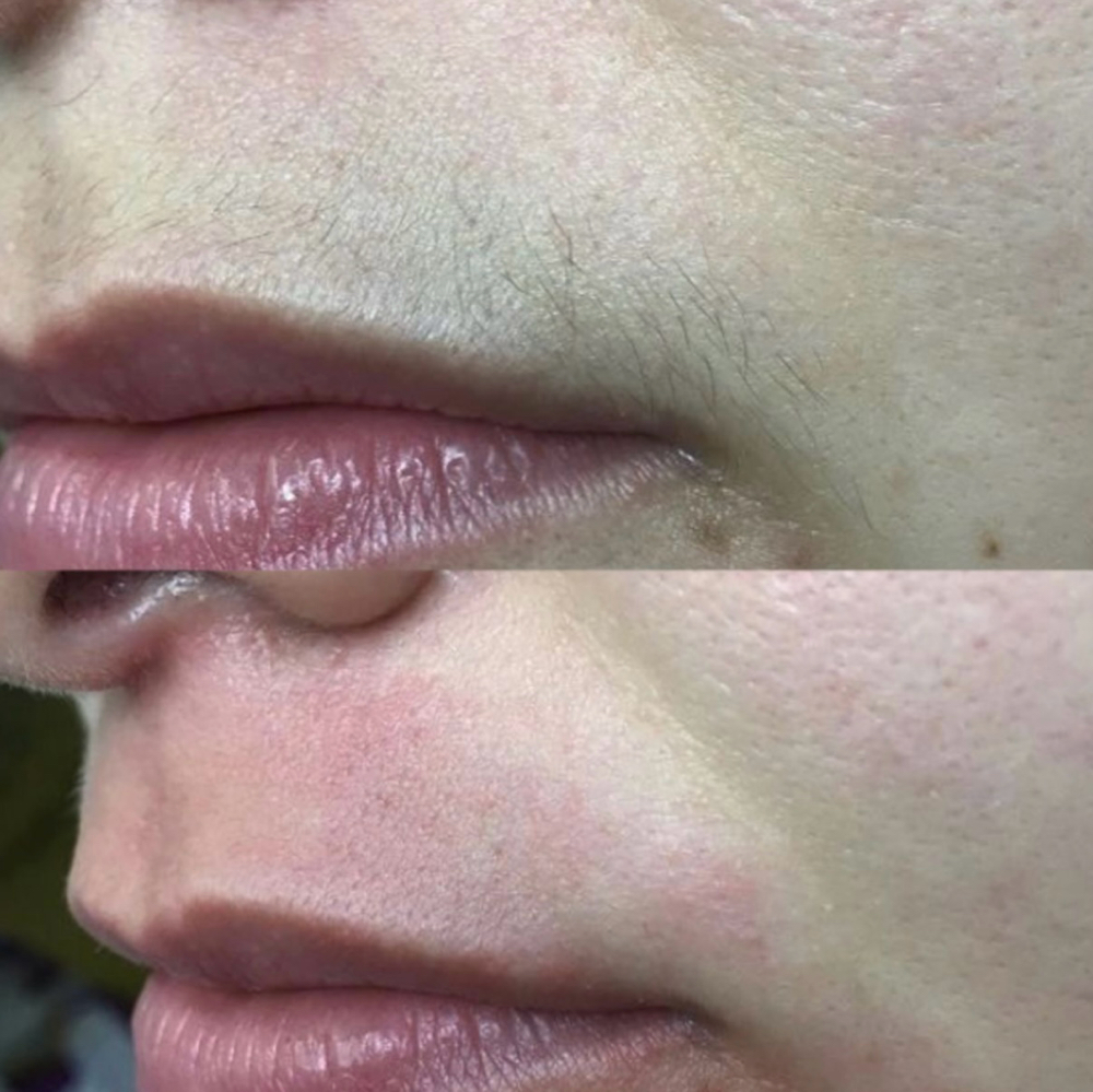 Upper lip Wax