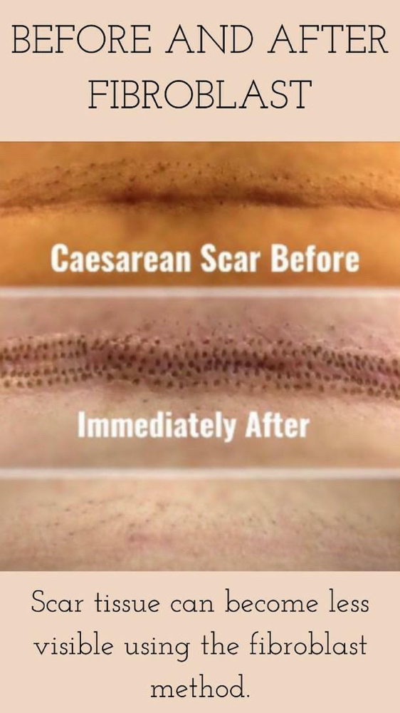 C-section/TummyTuck Scar Removal