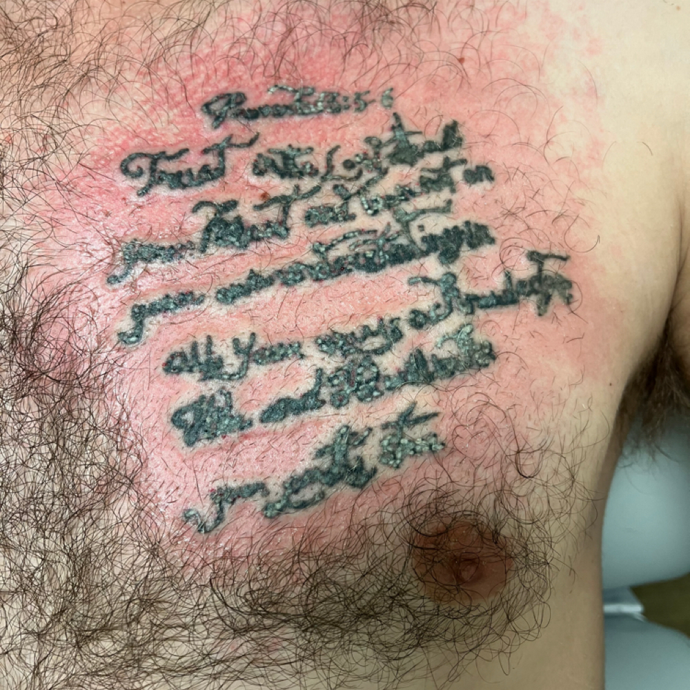 Laser Tattoo Removal at Genesis Health and Beauty Bar in Daphne, AL