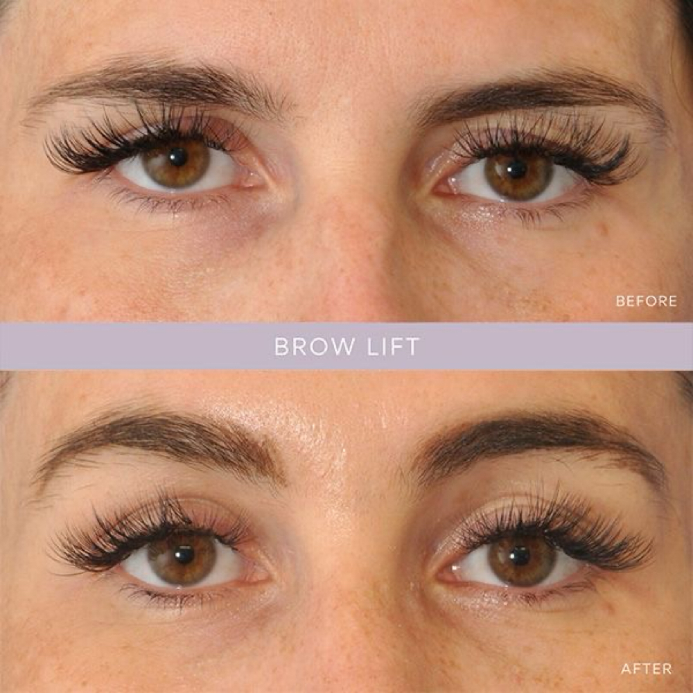 Brow Lift at Lilli Aesthetics LLC in Mansfield, TX
